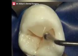 Image result for Tooth Decay Treatment with Dental Hook