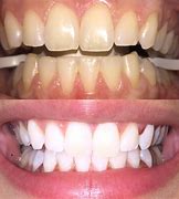 Image result for White Sharp Teeth