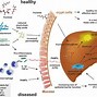 Image result for Fructose Malabsorption