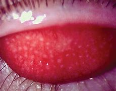 Image result for Conjunctival Papillae