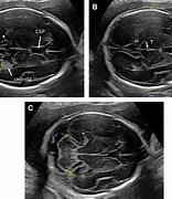 Image result for Fetal Brain Ultrasound