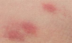 Image result for Rashes On Stomach