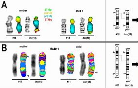 Image result for Pericentric Inversion of Chromosome 2