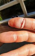 Image result for What Does 1 Cm Deep Cut Look Like
