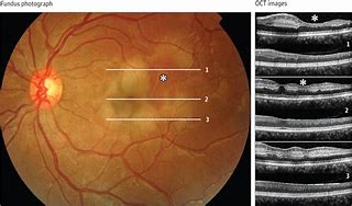 Image result for Sickle Cell Maculopathy Oct