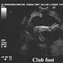 Image result for Sirenomelia Fetal Ultrasound