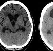 Image result for Hydrocephalus On CT Scan