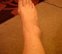 Image result for Broke My Ankle