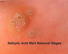 Image result for Professional Wart Removal