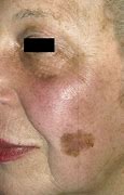 Image result for What Does Skin Cancer Look Like On the Face