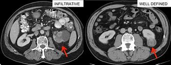 Image result for Malignant Kidney Tumor
