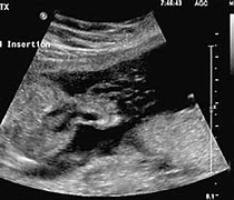 Image result for Holoprosencephaly Ultrasound Trisomy