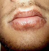 Image result for Severely Chapped Lips