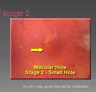 Image result for Macular Hole Stages