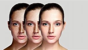 Image result for What Causes Your Face Melinan Fading