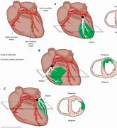 Image result for MI Signs and Symptoms