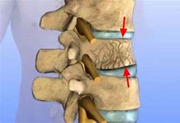 Image result for Broken Backbone Symptoms