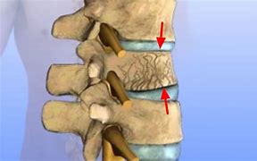 Image result for Lumbar Compression Fracture