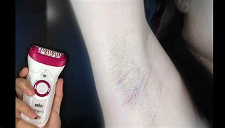 Image result for Epilator Before and After