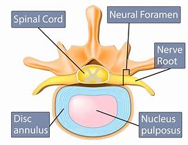 Image result for Spine Anatomy Spinal Stenosis