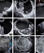 Image result for Stage 1 Ovarian Cancer Ultrasound
