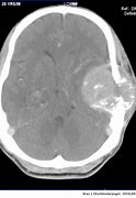 Image result for 7 Cm Tumor
