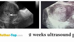 Image result for 2 Week Sonogram