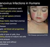Image result for Parvovirus Symptoms Humans