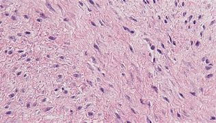 Image result for Fibromatosis Skin