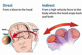 Image result for Football Concussion Brain Injury