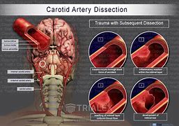 Image result for Carotid Artery Dissection