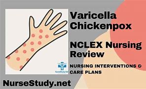 Image result for Chickenpox Transmission
