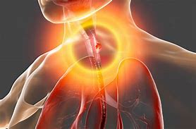 Image result for Esophageal Carcinoma