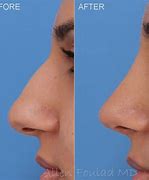 Image result for Nose Cartilage Surgery