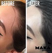 Image result for Female Hairline Microblading