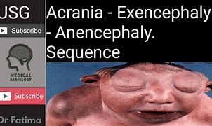 Image result for Anencephalic Babies