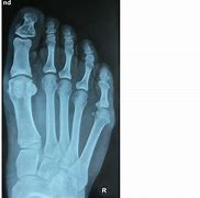 Image result for Metatarsal Foot Brace