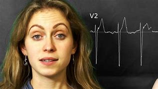 Image result for Hypokalaemia ECG Changes