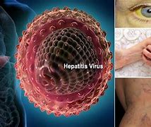 Image result for Difference Between Hepatitis A B and C