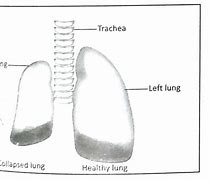 Image result for Thoravent Pneumothorax