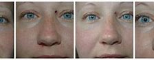 Image result for Mole Removal Healing Stages