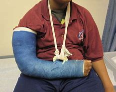 Image result for Broken Arm Cast Hoisted
