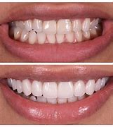 Image result for Best Teeth Veneers