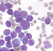 Image result for Acute Myeloid Leukemia without Maturation