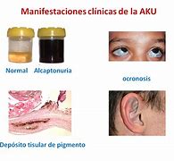 Image result for alcapronuria