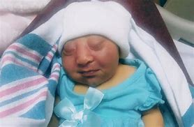 Image result for Worst Case Anencephaly