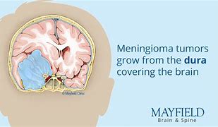 meningiomas 的图像结果