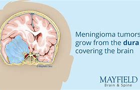 Image result for Benign Meningioma