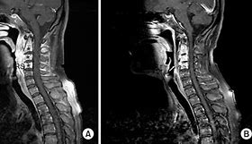 Image result for Cervical Spine MRI with Contrast