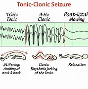 Image result for Tonic-Clonic Seizure